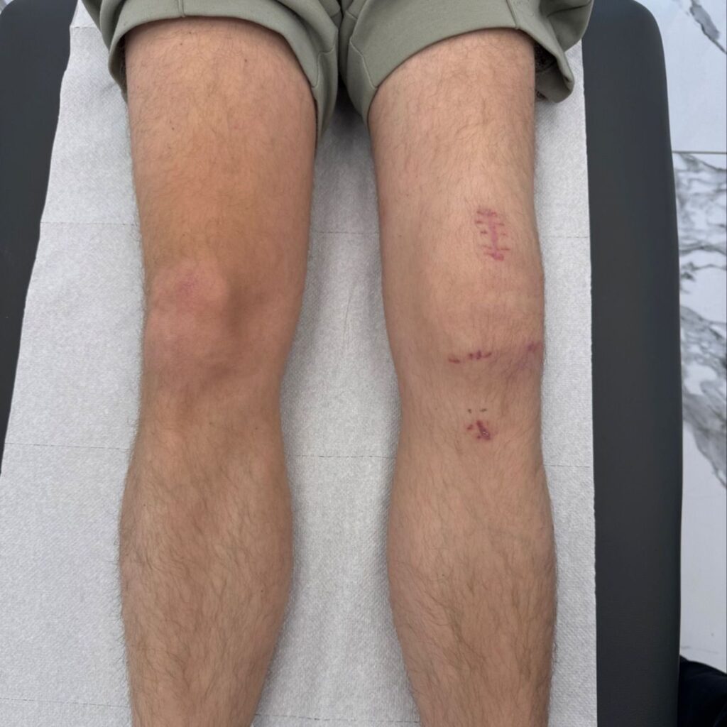 Przeszczep rekonstrukcja ACL