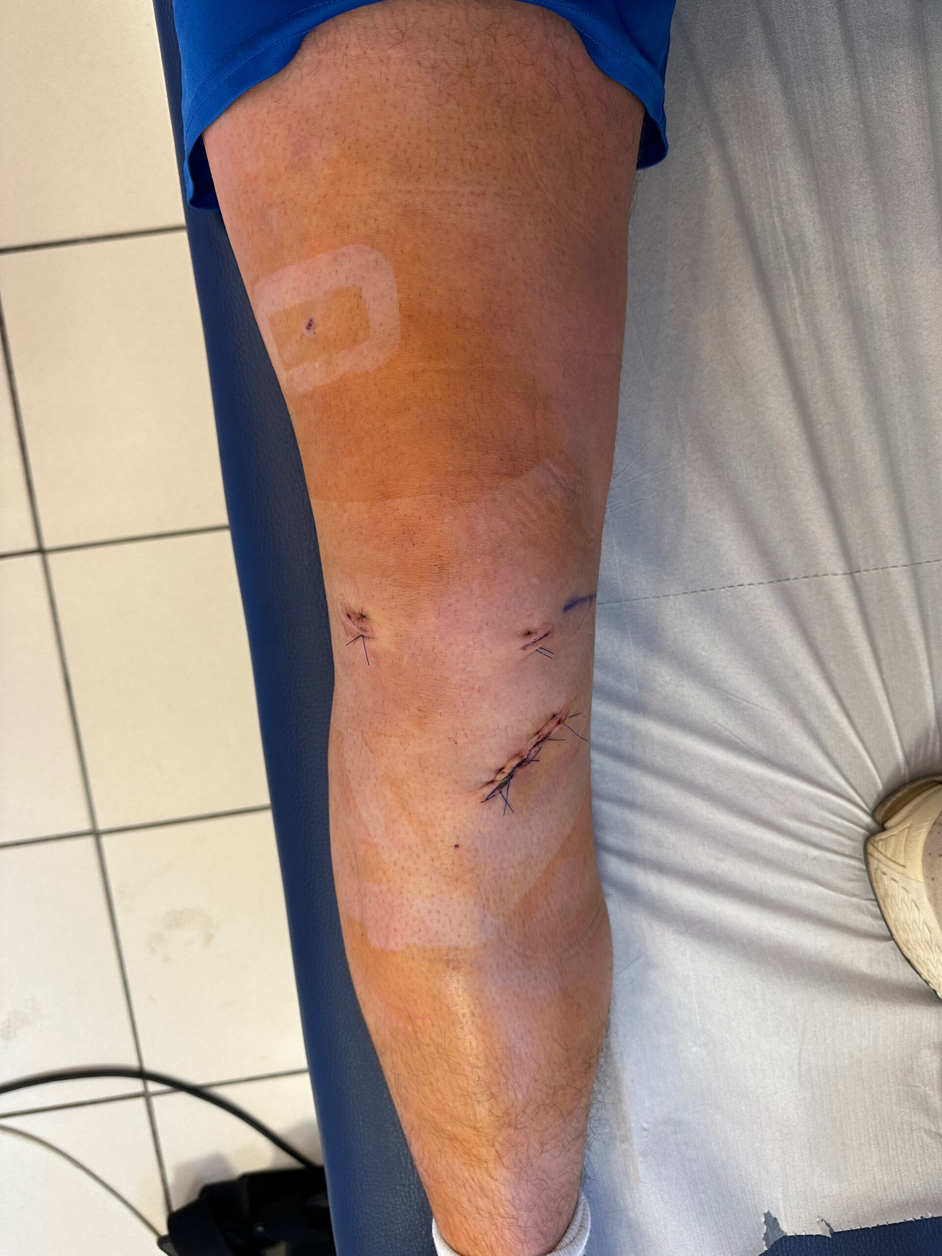 Ćwiczenia po rekonstrukcji ACL