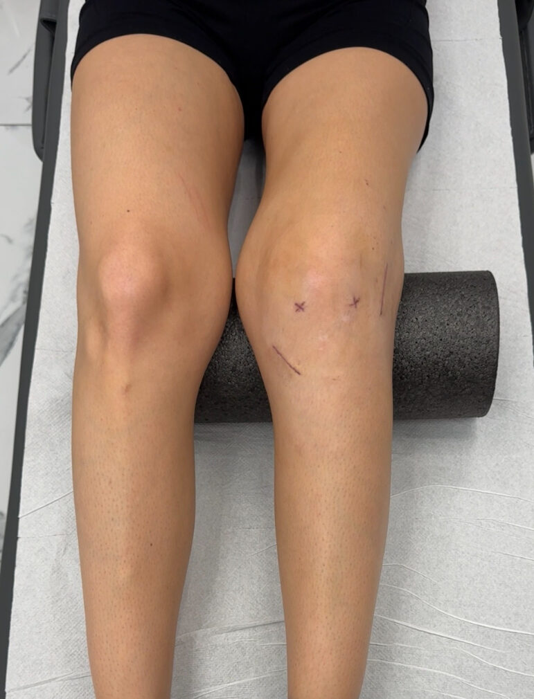 Rehabilitacja po rekonstrukcji ACL